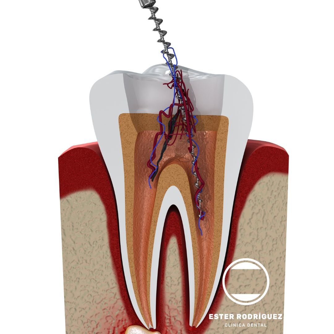 Limpieza dental en Salamanca | Ester Clínica Dental