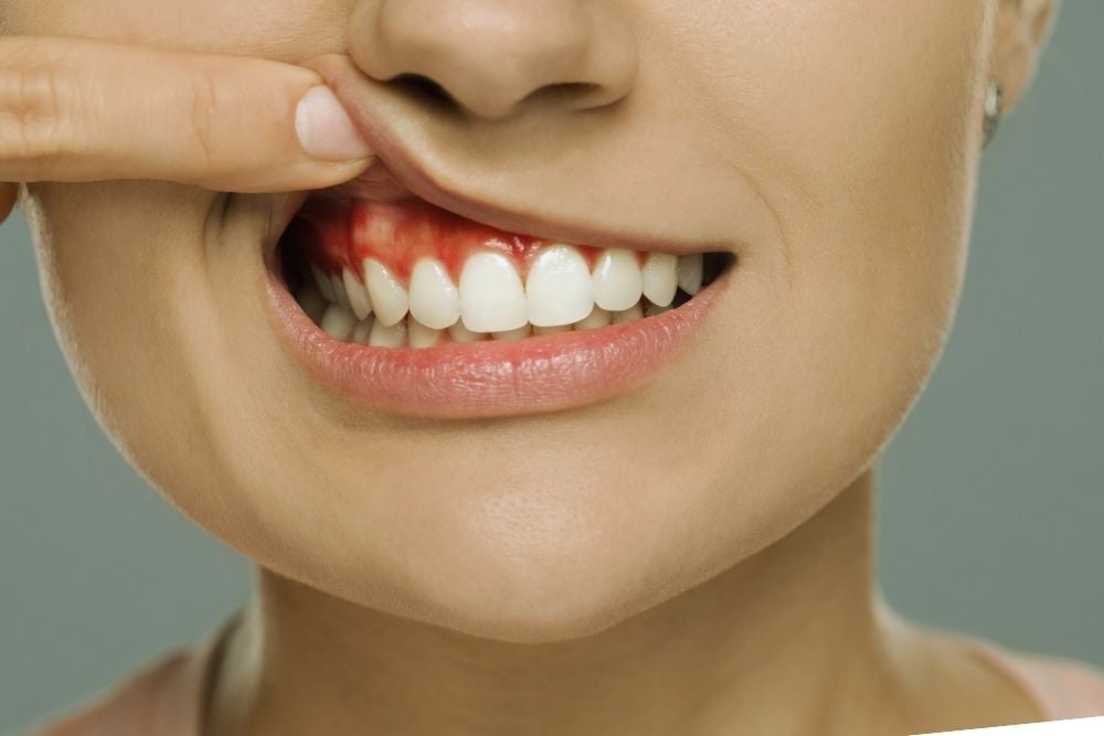 Flemon en la boca | Ester Rodríguez Clínica Dental