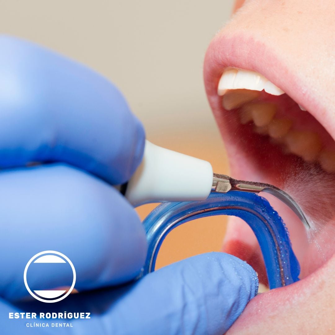 Limpieza dental en Salamanca | Ester Clínica Dental