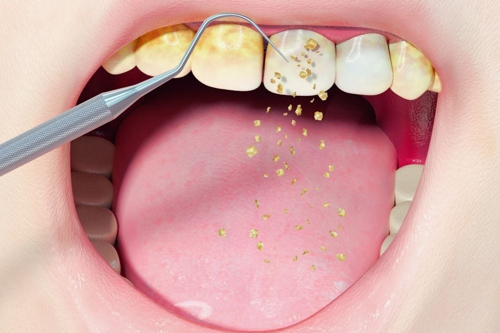 Placa dental: Causas, efectos y cómo prevenirla / Ester Rodriguez Clínica Dental