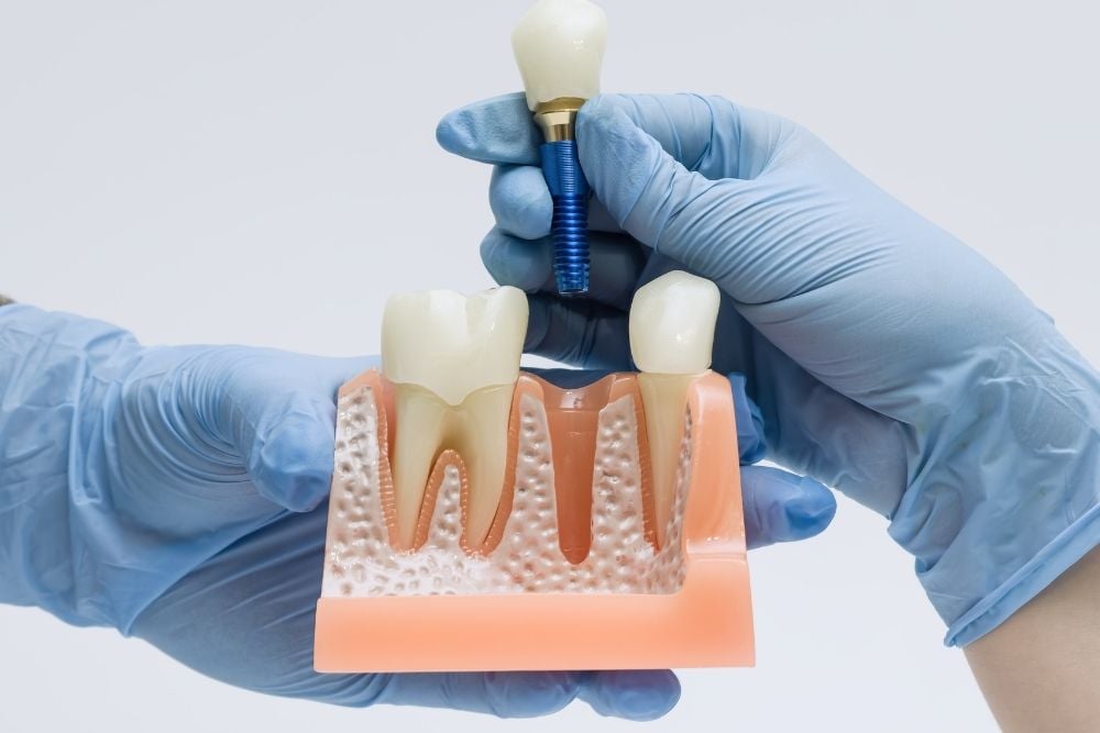 Cuándo no se pueden poner implantes dentales / Ester Rodriguez Clínica Dental