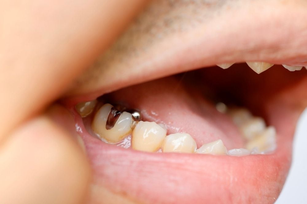 Limpiar fundas de los dientes / Ester Rodríguez Clínica Dental