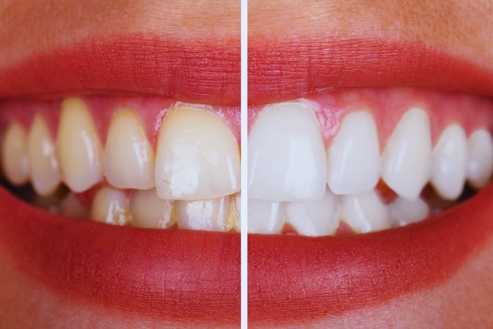 Blanqueamiento dental con férulas para una sonrisa más brillante | Ester Rodriguez Clínica Dental