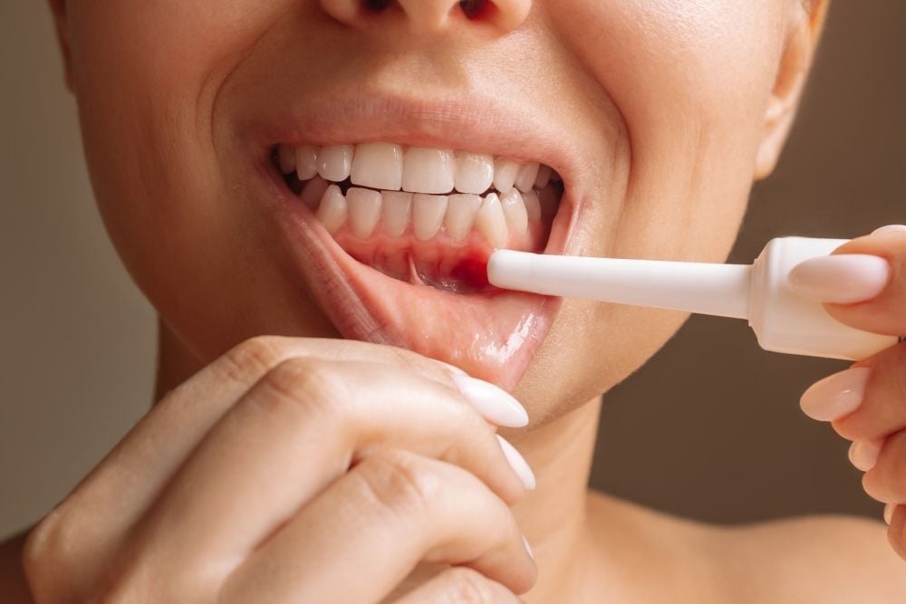 Causas de las boqueras / Ester Rodriguez Clínica Dental