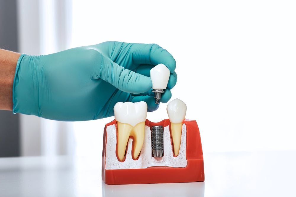 ¿Cómo calmar el dolor tras un implante dental? | Ester Rodríguez Clínica Dental en Salamanca