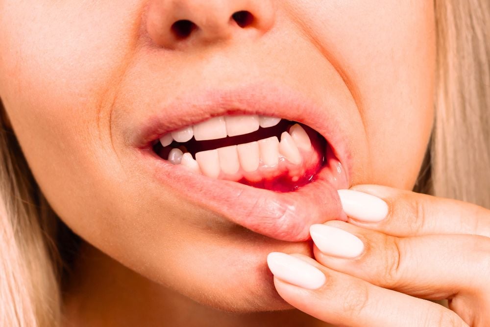 ¿Por qué se producen las heridas en la encía y cómo tratarlas? / Ester Rodriguez Clínica Dental