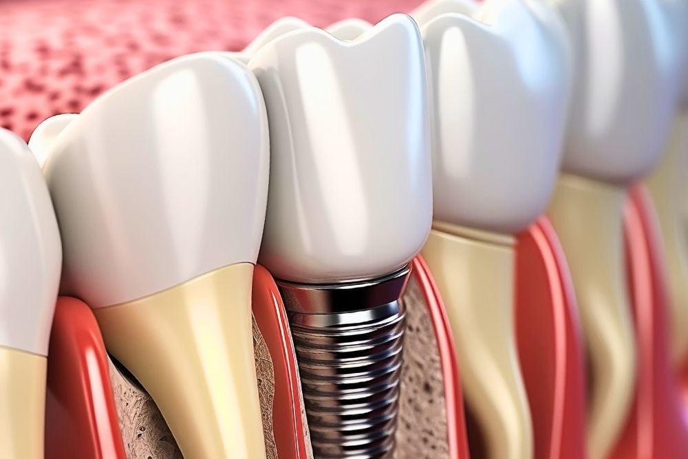 Implante infectado: causas, síntomas y tratamientos en Clínica Dental Ester Rodríguez / Ester Rodriguez Clínica Dental