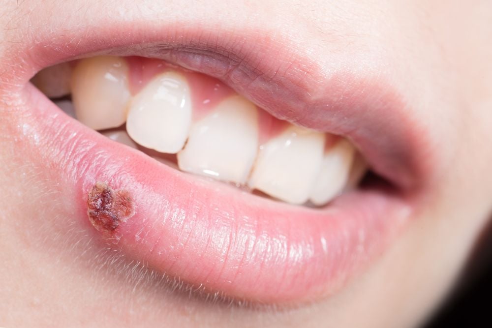 Llaga en la boca durante el embarazo | Ester Rodriguez Clínica Dental