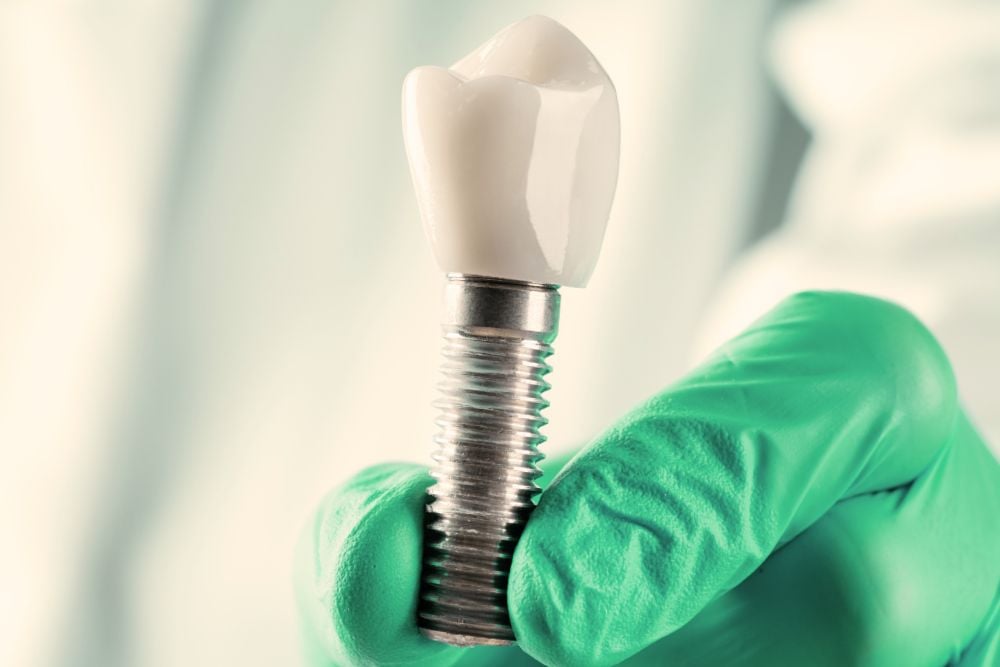 ¿Poner implantes dentales duele? Todo lo que necesitas saber | Ester Rodríguez Clínica Dental en Salamanca