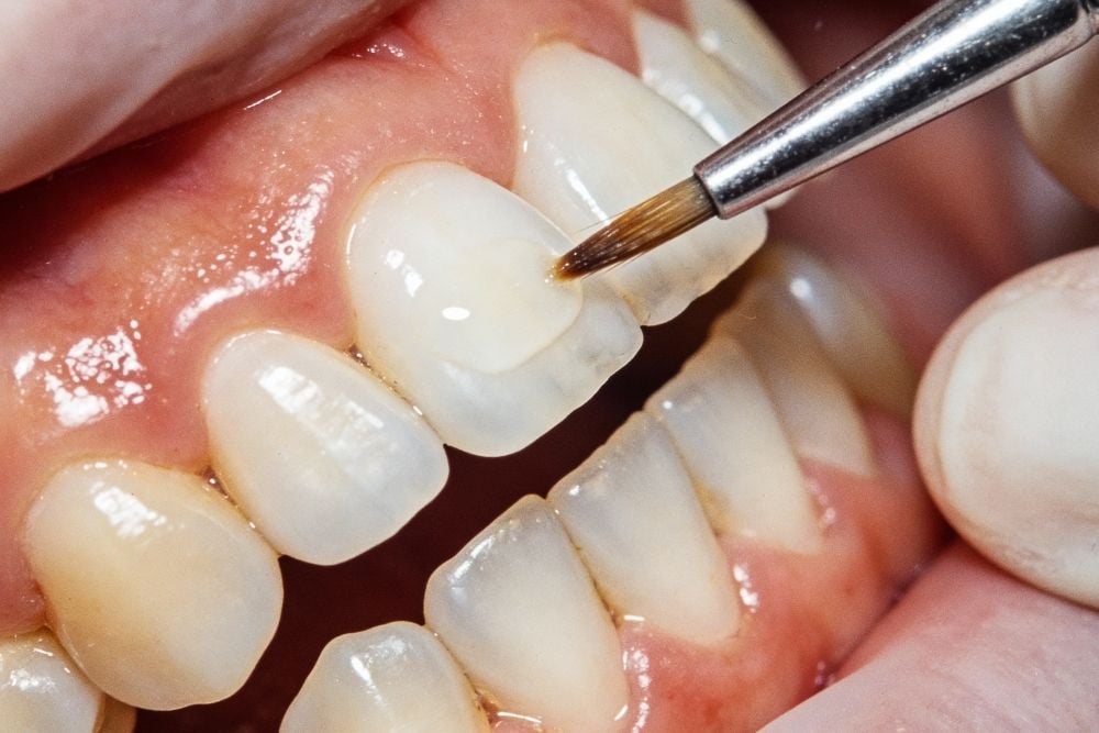 Qué es la agenesia dental / Ester Rodríguez Clínica dental